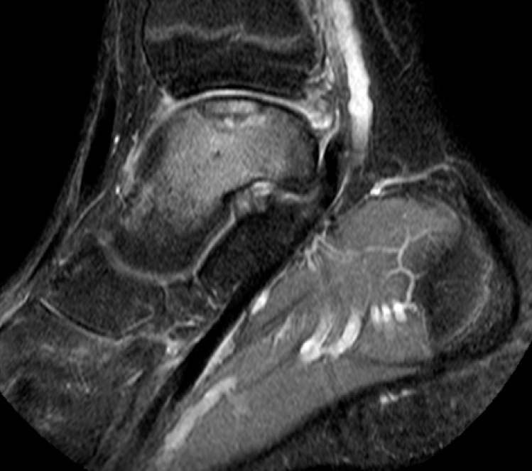 Figure 3 for case Osteochondral lesion talar dome